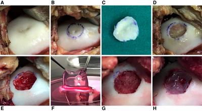 Four cases report: Treatment of knee joint cartilage defects using autologous chondrocyte patch implantation